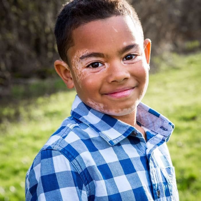 çocuk ve vitiligo