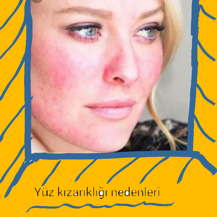 kırmızı yüze sahipseniz