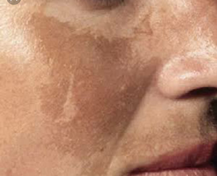 melasma tedavisinde...