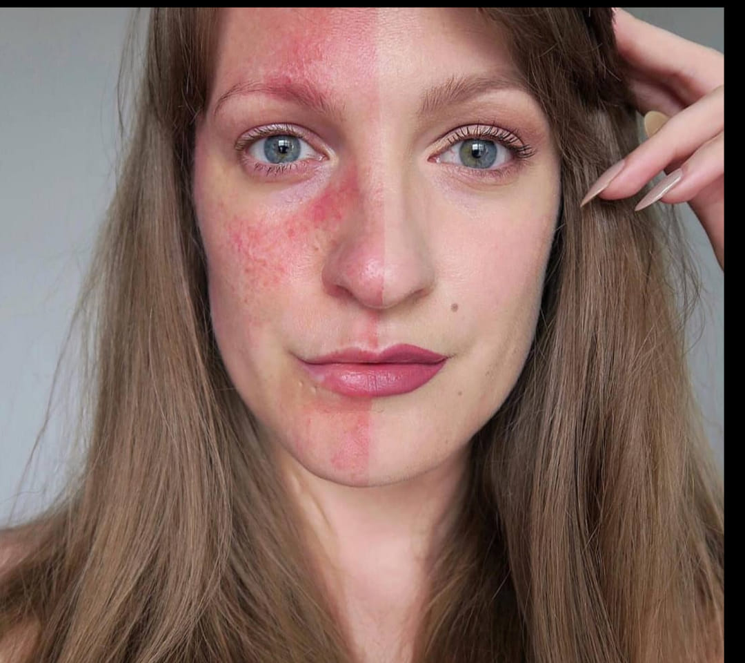 Rosacea mısınız; okumanızda şifa var bu yazıyı