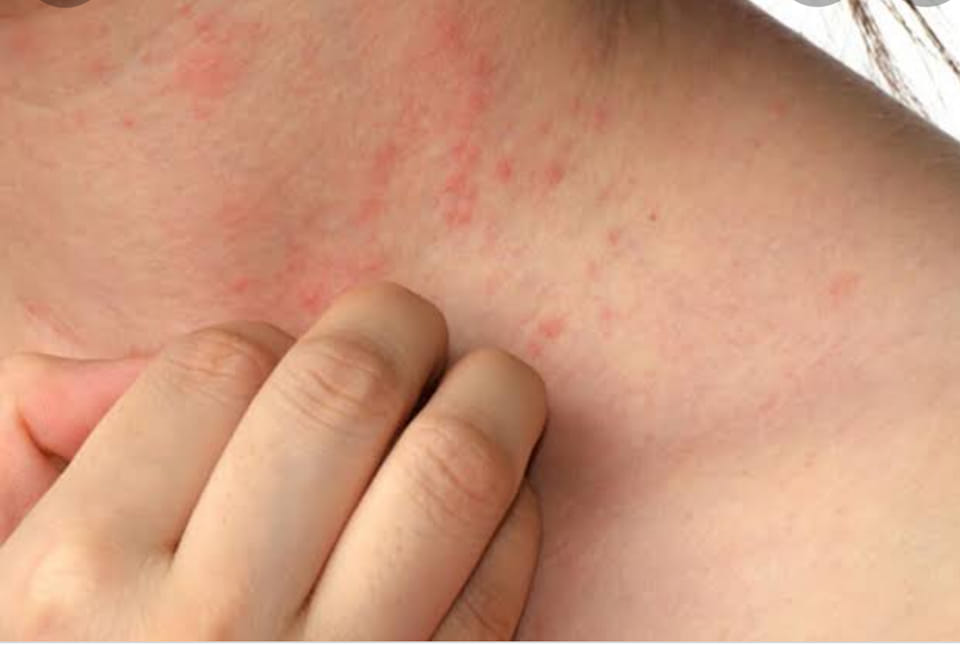 Uyuz hastalığı konusunda arkadaşımla söyleştik